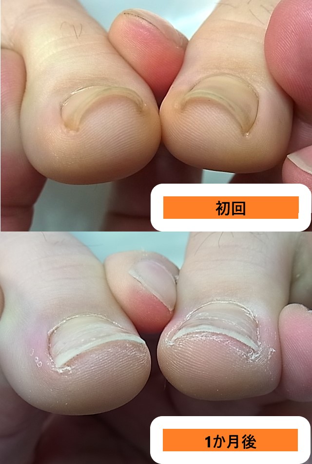 小学生の娘の症例ビフォーアフター