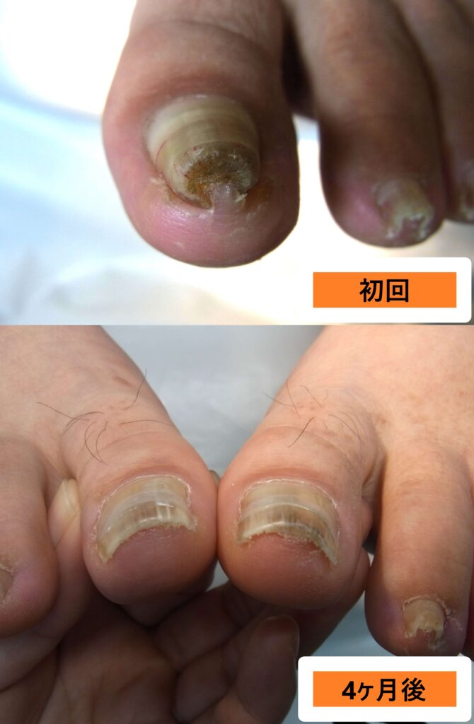 サンダル以外好きな靴が履けない症例ビフォーアフター