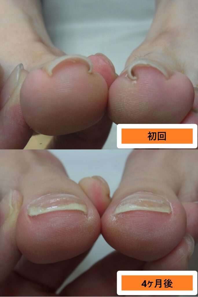 出産経験ありの症例ビフォーアフター