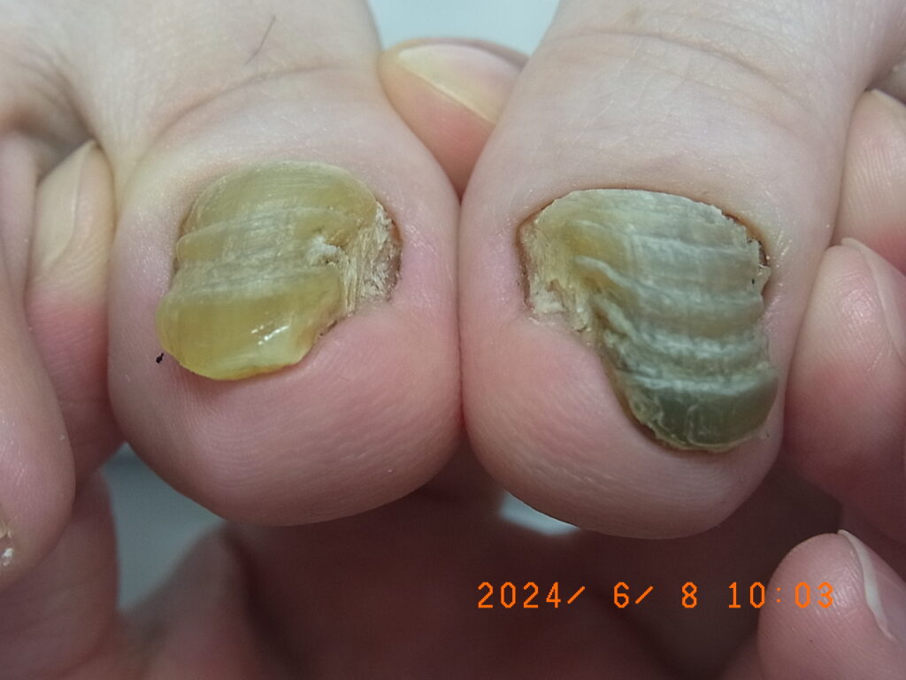 福島巻き爪矯正院爪甲鉤彎症症例