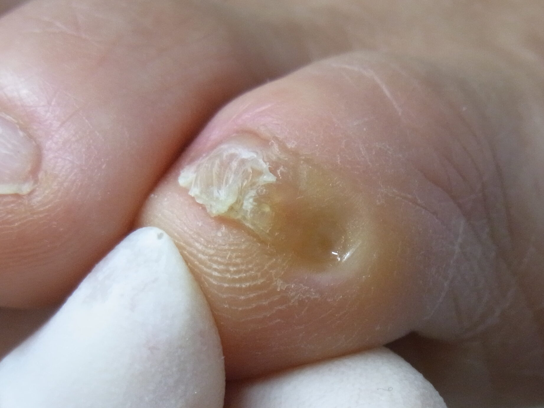 施術後の副爪
角質化していた皮膚を削り取ることにより、痛みや引っかかりがなくなる。