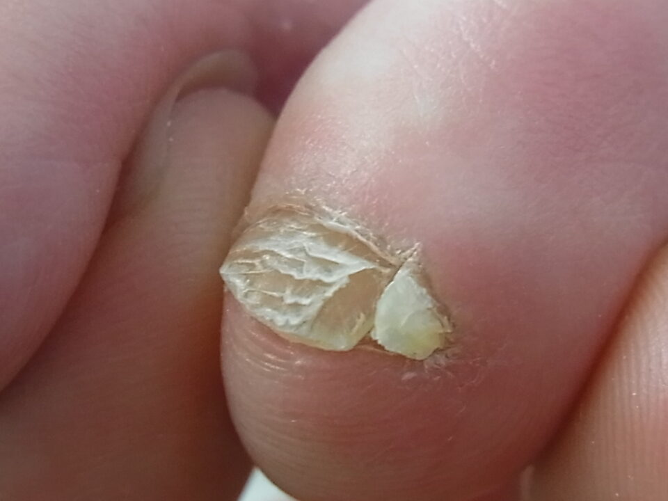副爪の一例
爪のように見えるが、皮膚が角質化してできる、たこのようなもの。
引っかけたり、ぶつけると痛みがある。