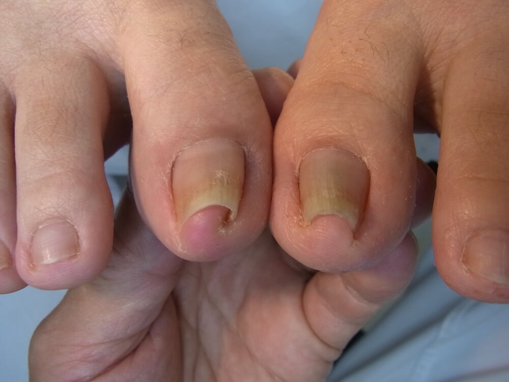 池袋の東京巻き爪矯正院　重度巻き爪症例写真