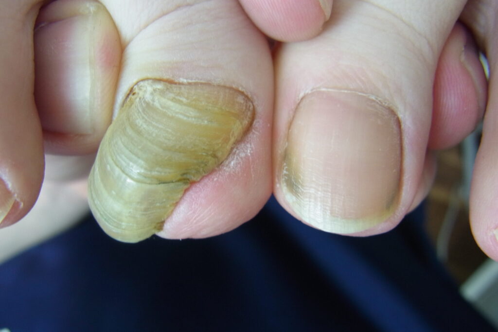 東京巻き爪矯正院　池袋院　爪甲鉤彎症