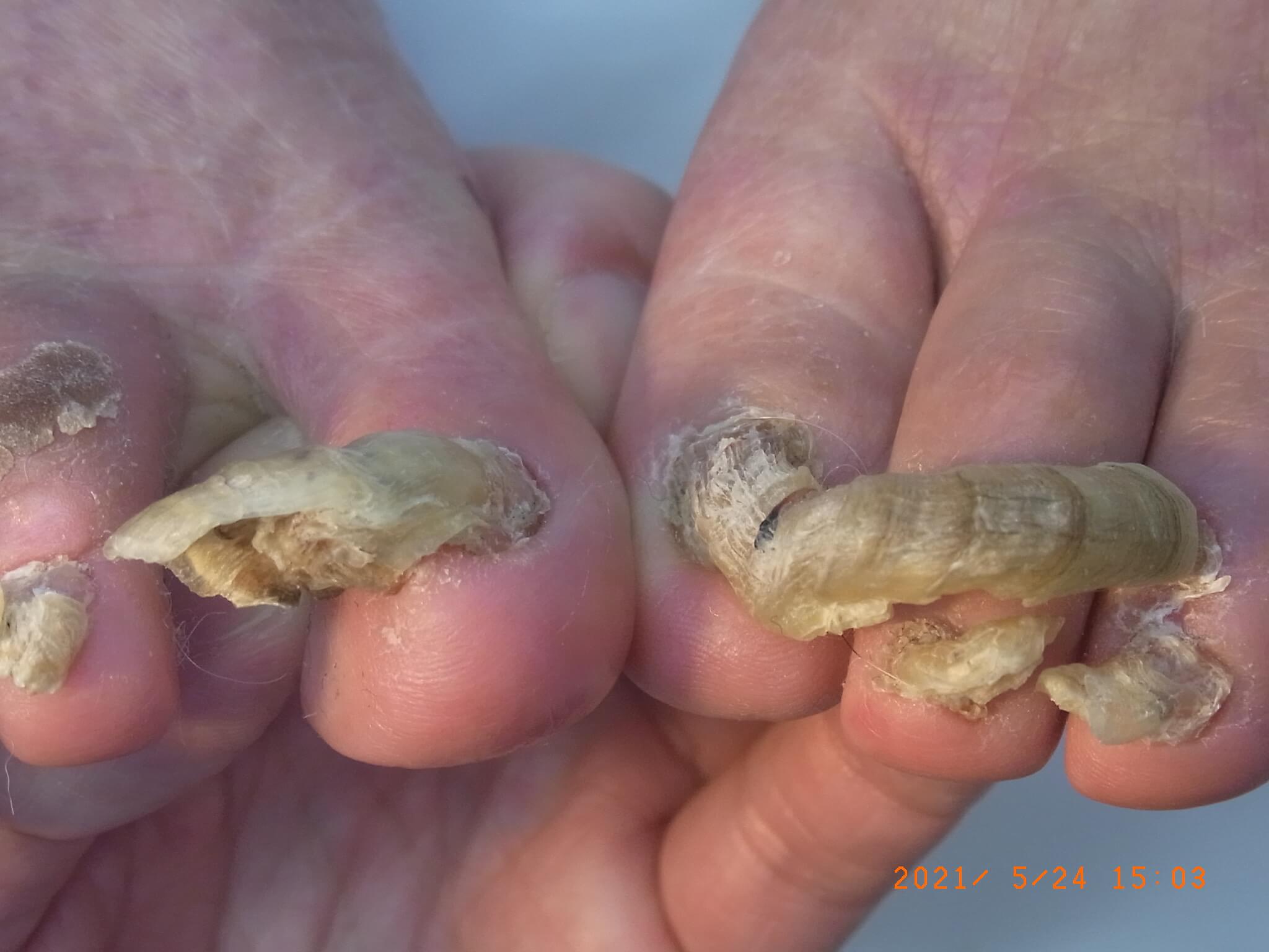 東京巻き爪矯正院 高齢者爪症例