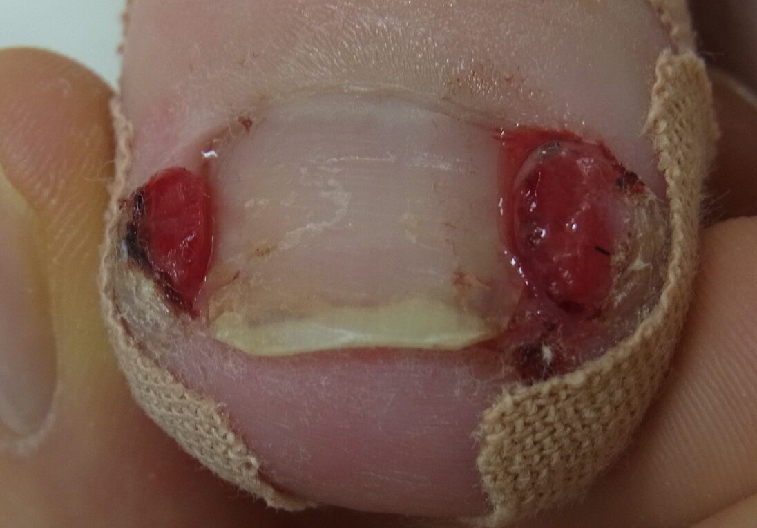 東京巻き爪矯正院　化膿患者　写真