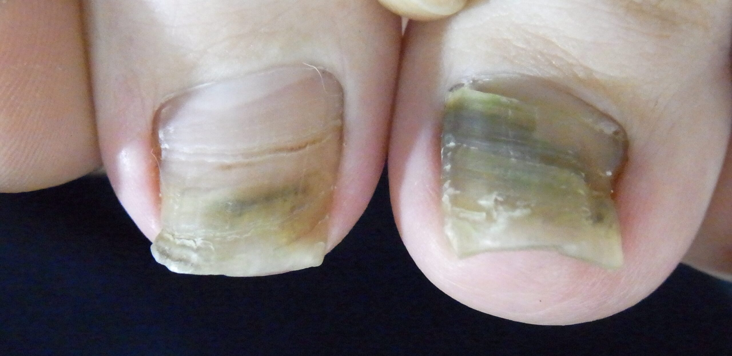 グリーンネイル症例画像