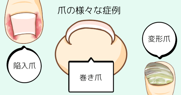 千葉巻き爪矯正院 柏院 爪症例