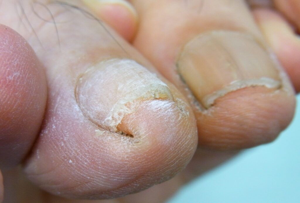 爪棘症例写真 施術前