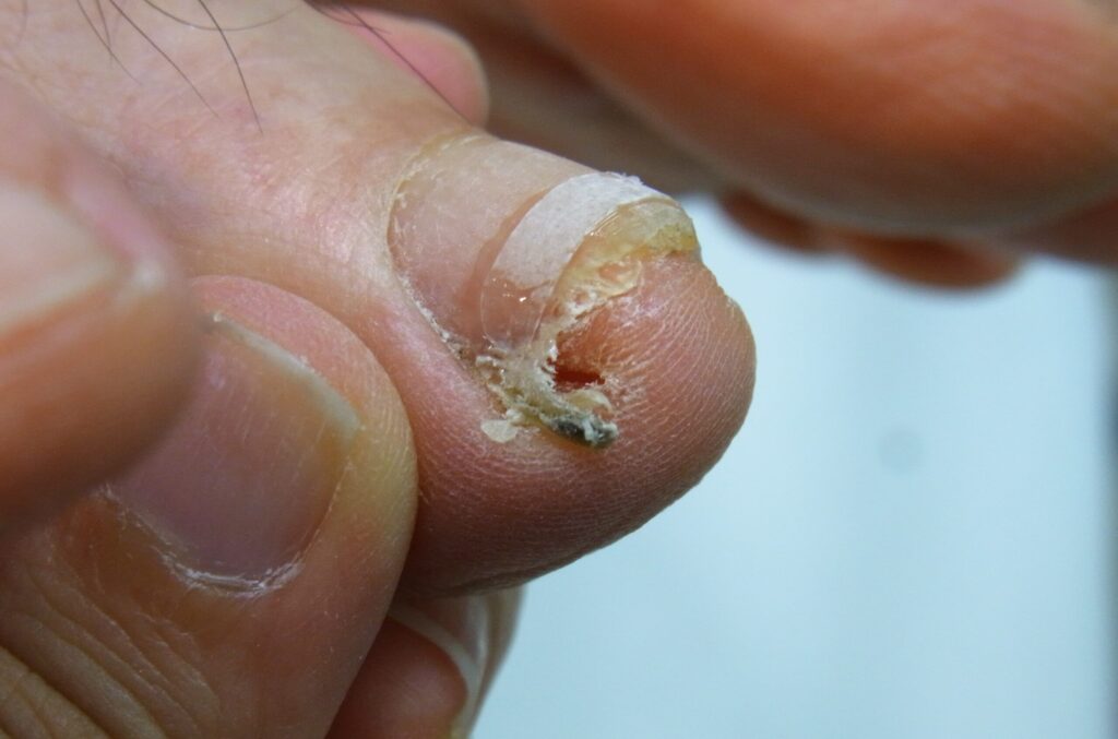 爪棘症例写真 施術後