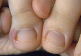 東京巻き爪矯正院深爪陥入爪写真