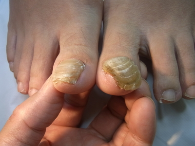 いわき巻き爪矯正院　爪甲鉤彎症症例画像