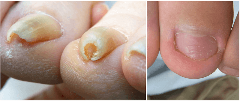 柏の巻き爪矯正院　巻き爪と陥入爪の症例写真