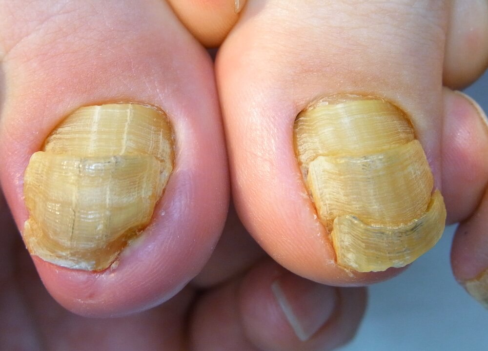 柏市の巻き爪矯正院の爪甲鉤彎症（変形爪）症例