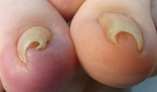 川口市の埼玉巻き爪矯正院 川口院　巻き爪症例画像