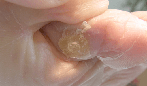 川口市の埼玉巻き爪矯正院 川口院　タコウオノメ角質ケア画像