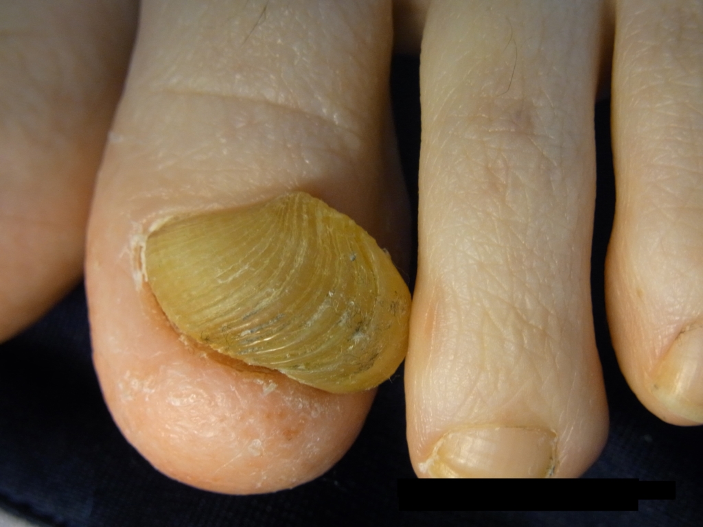 川口市の巻き爪矯正院　変形爪修復-肥厚爪-