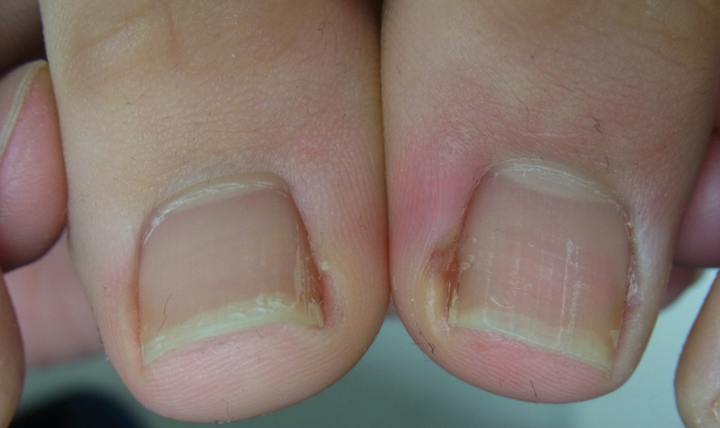 埼玉巻き爪矯正院川口院症例写真