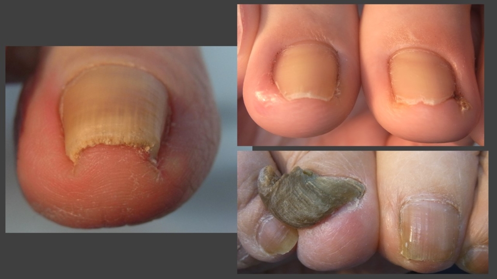 埼玉巻き爪矯正院川口院　巻き爪の種類画像