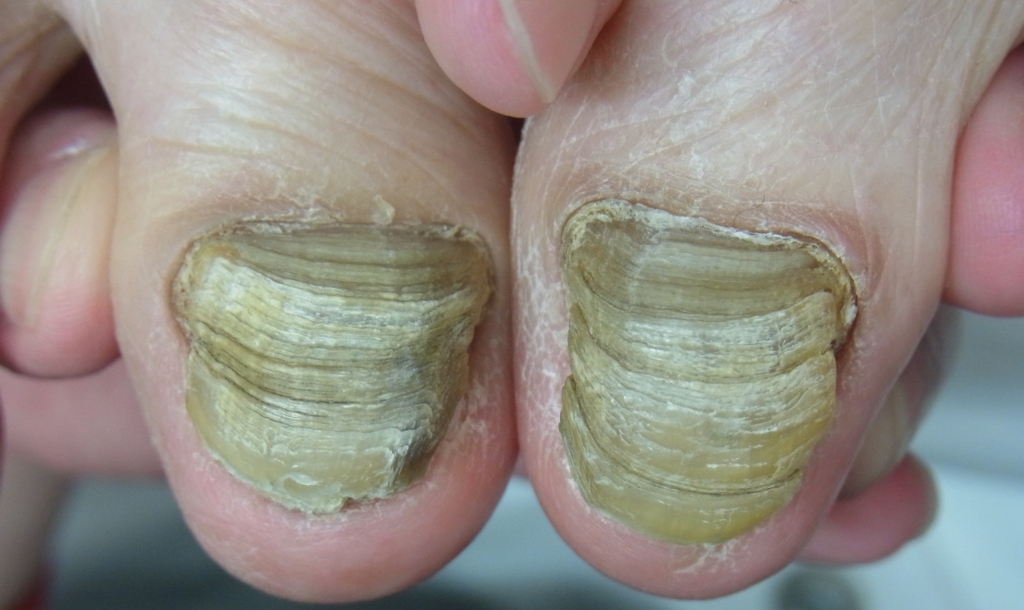 埼玉巻き爪矯正院川口院変形爪写真