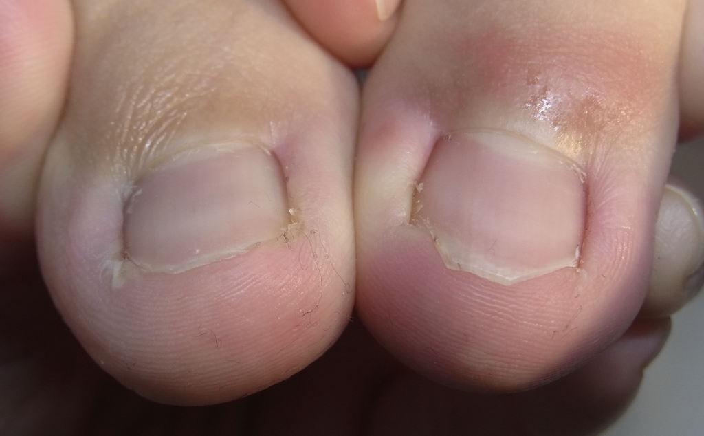 川口市の埼玉巻き爪矯正院 川口院　陥入爪画像