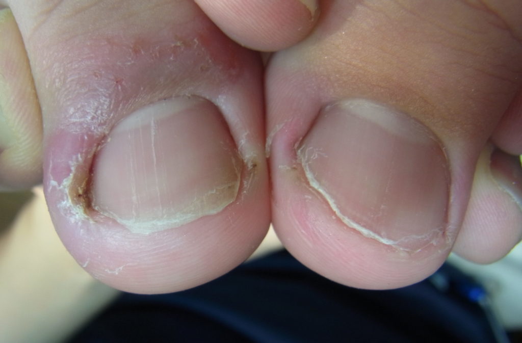 陥入爪矯正について