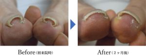 越谷の巻き爪矯正施術前後