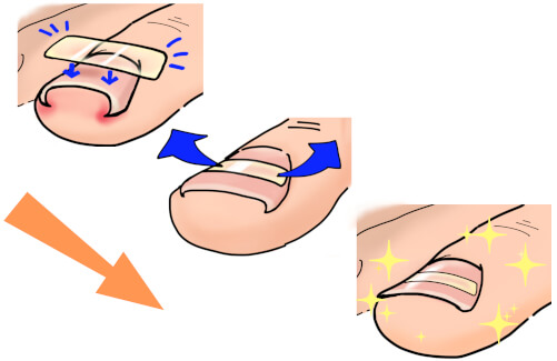 越谷巻き爪の矯正イメージ