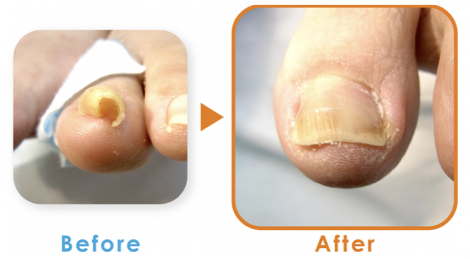 越谷院の重度巻き爪改善症例画像