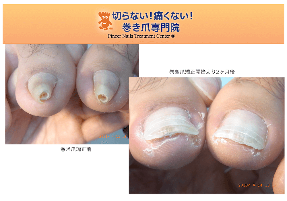 巻き爪重度矯正改善例画像