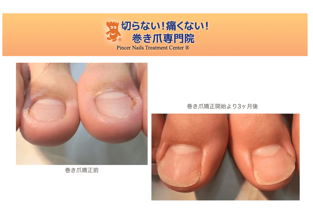 深爪陥入爪矯正改善症例画像