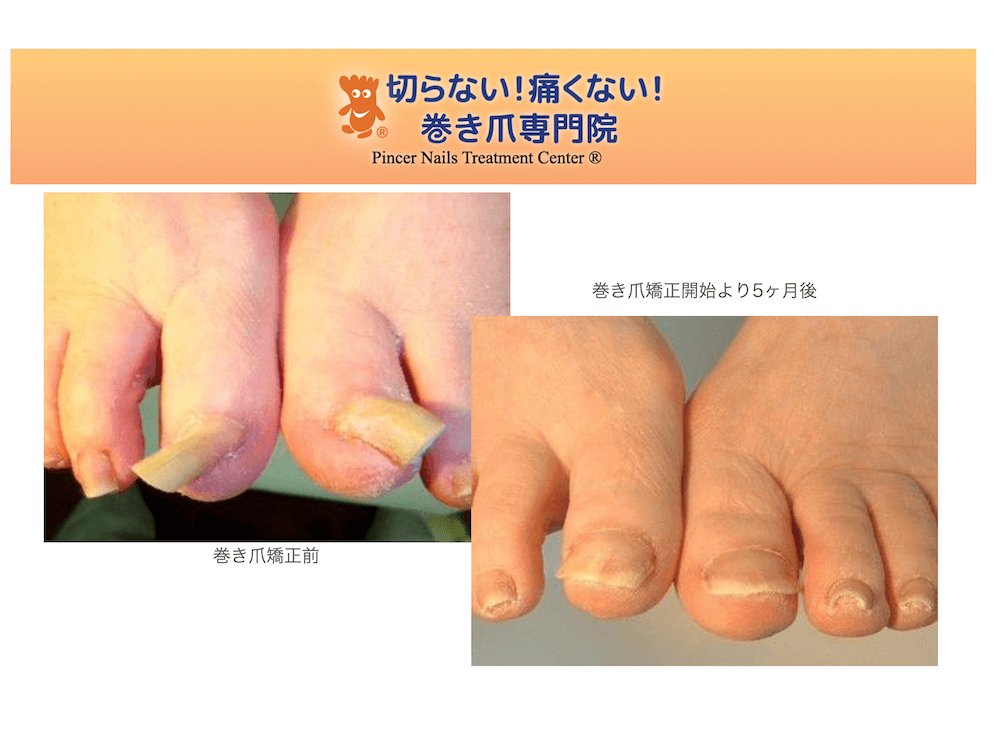 肥厚巻き爪矯正改善症例画像