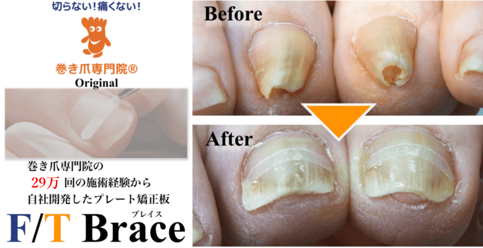 越谷市の巻き爪矯正専門【埼玉巻き爪矯正院】の施術方法