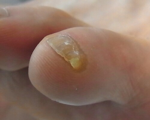 副爪施術前画像