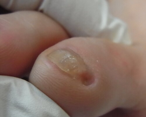 副爪施術後画像