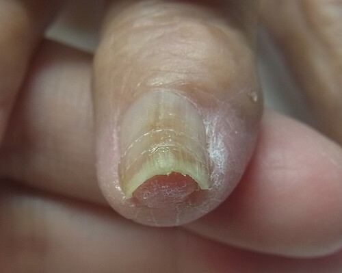 手の巻き爪施術後