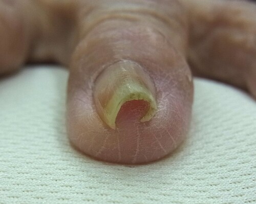 手の巻き爪施術前