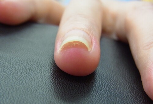 手の巻き爪症例