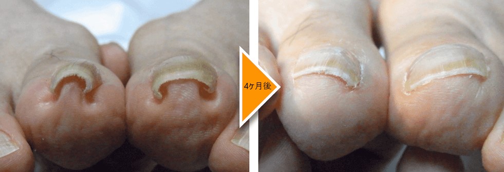 巻き爪専門院のプレート矯正の施術効果例画像