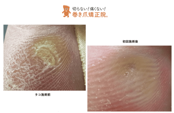 タコ 三鷹院の症例画像