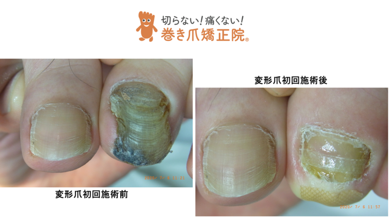 変形爪 三鷹院の症例画像