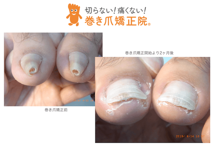 巻き爪重度矯正 三鷹院の症例画像