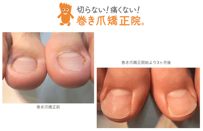 深爪陥入爪矯正 三鷹院の症例画像