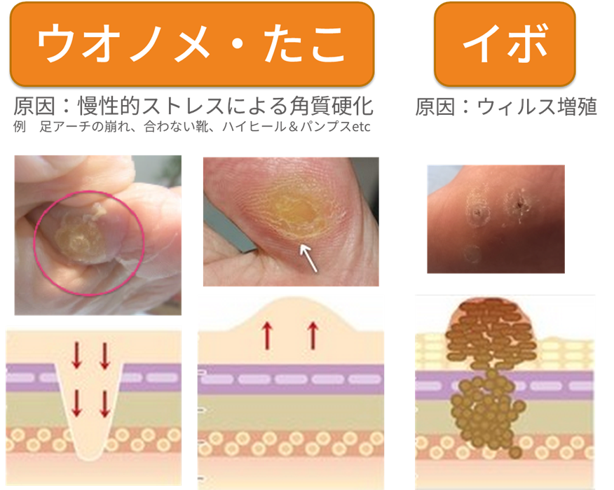 タコウオノメイボ比較画像