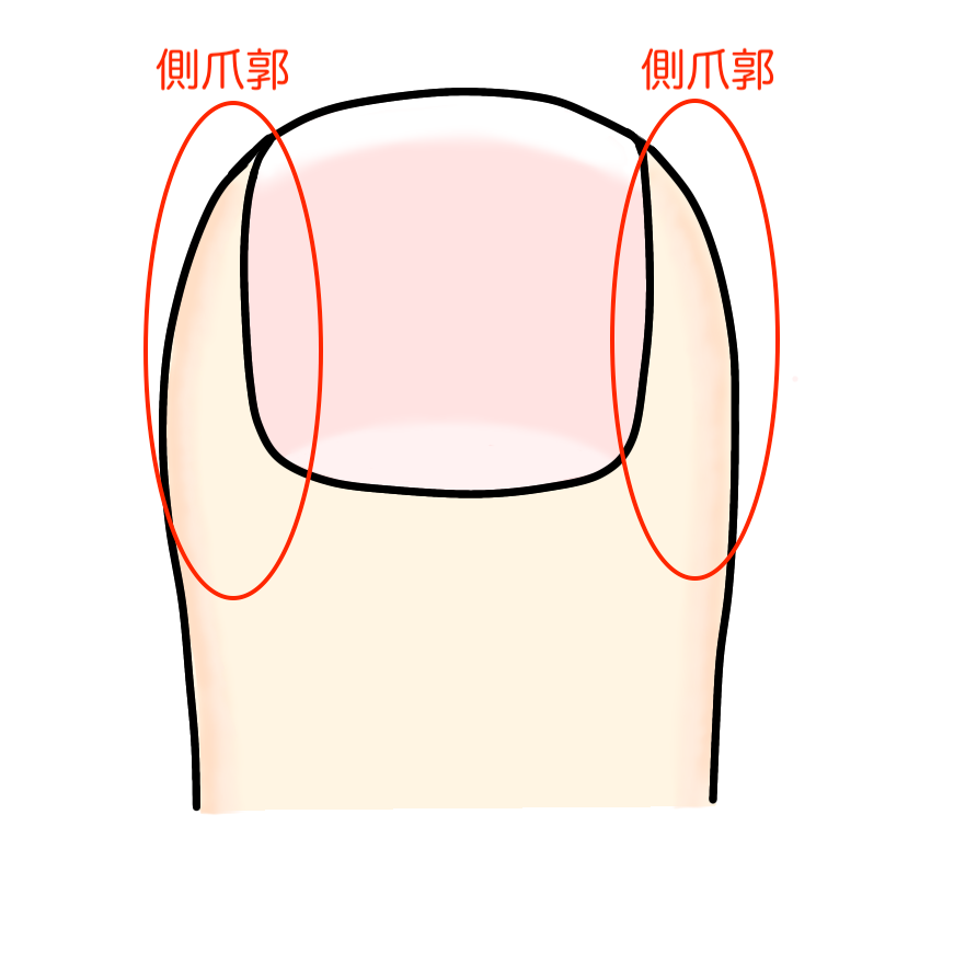 陥入爪で痛む部分側爪郭