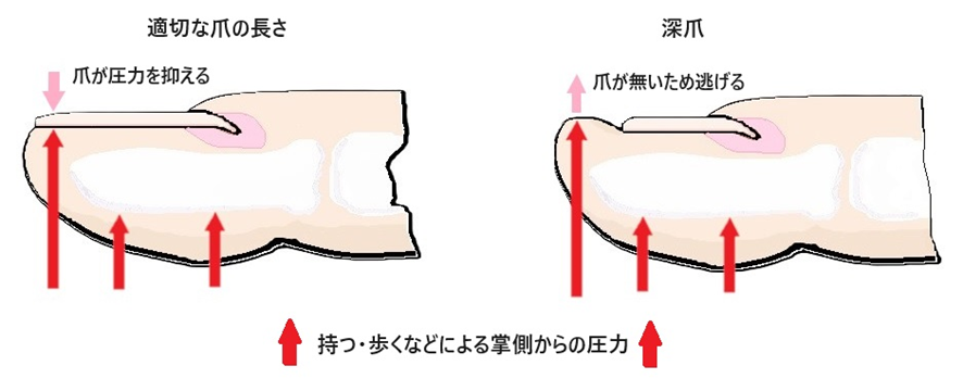 深爪トラブル