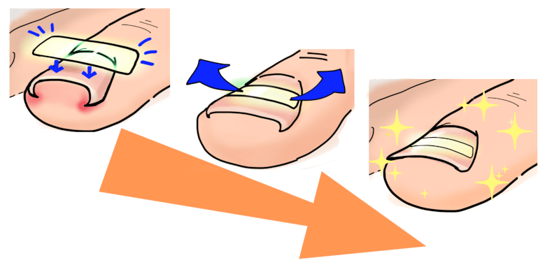 千葉巻き爪矯正院 柏院 施術進行イメージ図