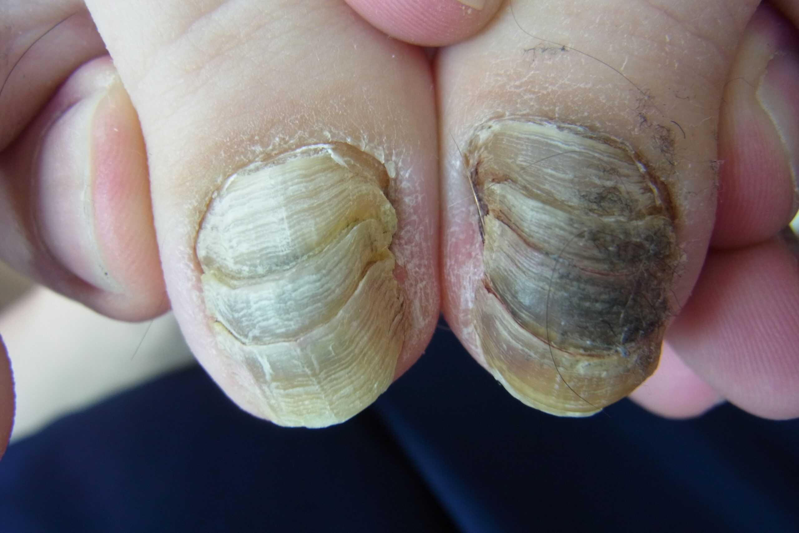 爪甲鉤彎症症例写真