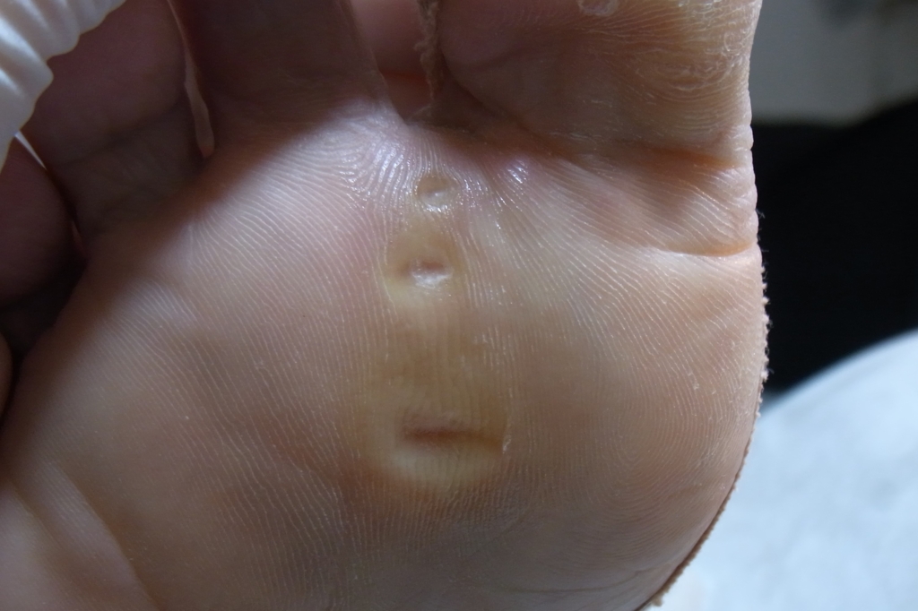タコ症例施術後写真