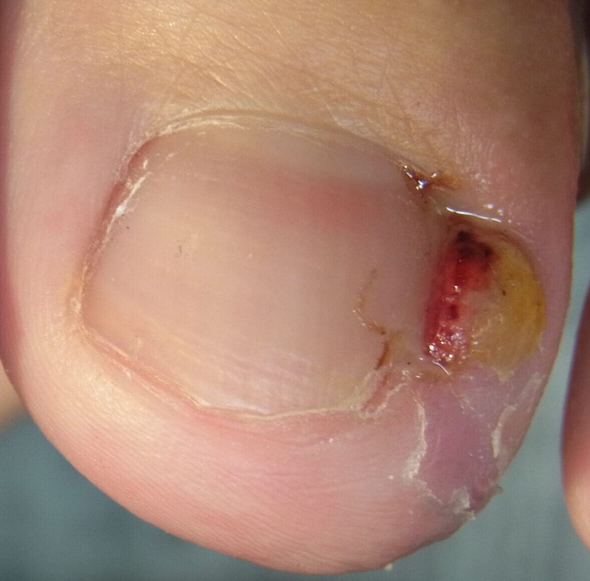 埼玉巻き爪矯正院所沢院の化膿症例写真